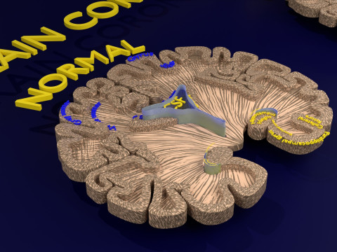 Hippocampus atrophy levels MTA 1-4 Model 3D