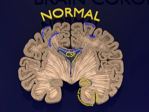 Hippocampus atrophy levels MTA 1-4 3D Model