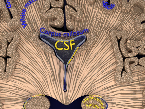 Hippocampus atrophy levels MTA 1-4 Model 3D