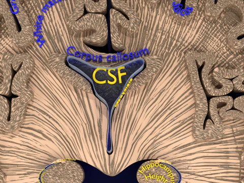 Hippocampus atrophy levels MTA 1-4 3D Model