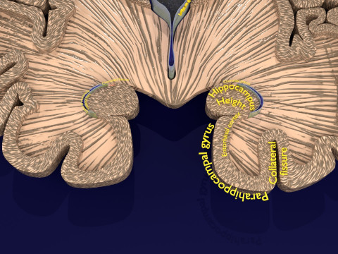 Hippocampus atrophy levels MTA 1-4 Model 3D