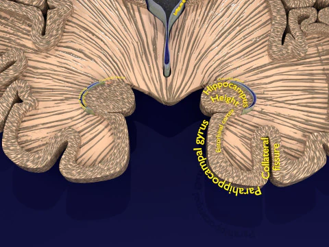 Hippocampus atrophy levels MTA 1-4 3D Model