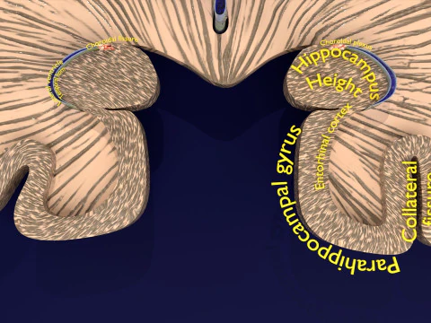 Hippocampus atrophy levels MTA 1-4 3D Model