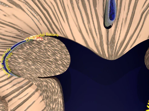 Hippocampus atrophy levels MTA 1-4 3D Model