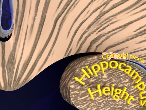 Hippocampus atrophy levels MTA 1-4 3D Model