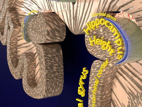 Hippocampus atrophy levels MTA 1-4 3D Model