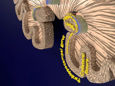 Hippocampus atrophy levels MTA 1-4 3D Model