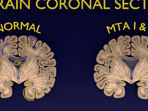 Hippocampus atrophy levels MTA 1-4 3D Model