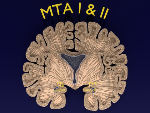 Hippocampus atrophy levels MTA 1-4 Model 3D