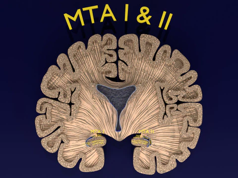 Hippocampus atrophy levels MTA 1-4 3D Model