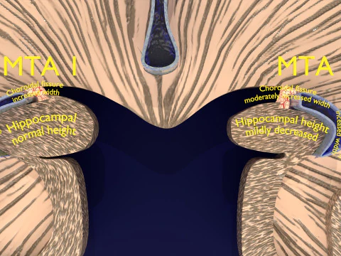 Hippocampus atrophy levels MTA 1-4 3D Model