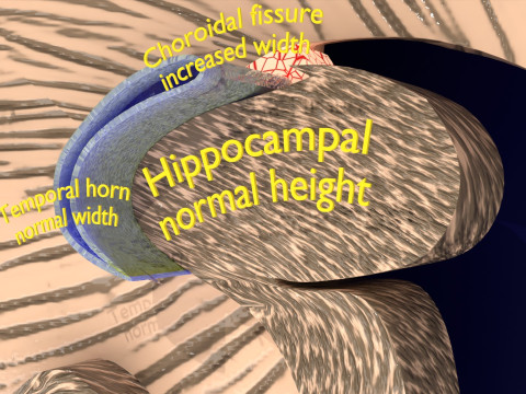 Hippocampus atrophy levels MTA 1-4 Model 3D