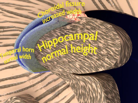 Hippocampus atrophy levels MTA 1-4 3D Model