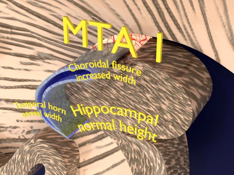 Hippocampus atrophy levels MTA 1-4 3D Model