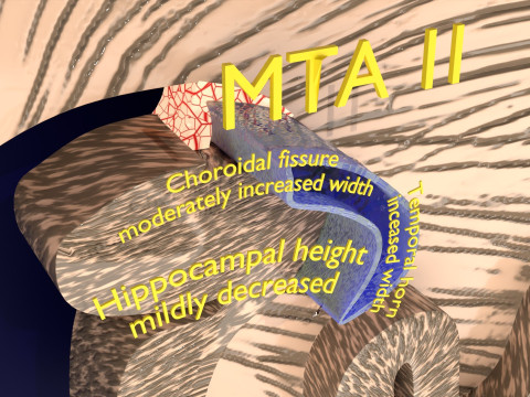 Hippocampus atrophy levels MTA 1-4 Model 3D