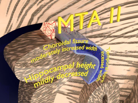 Hippocampus atrophy levels MTA 1-4 3D Model