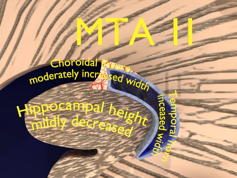 Hippocampus atrophy levels MTA 1-4 3D Model