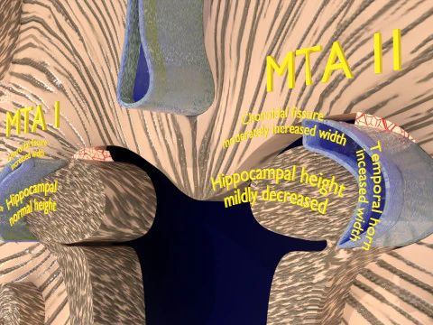 Hippocampus atrophy levels MTA 1-4 3D Model
