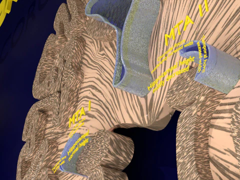 Hippocampus atrophy levels MTA 1-4 3D Model
