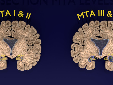 Hippocampus atrophy levels MTA 1-4 Model 3D