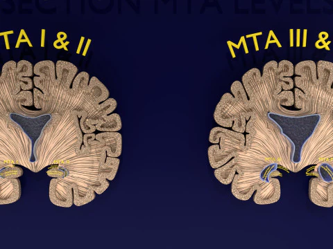 Hippocampus atrophy levels MTA 1-4 3D Model
