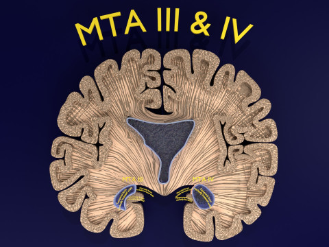 Hippocampus atrophy levels MTA 1-4 Model 3D