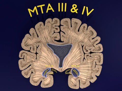 Hippocampus atrophy levels MTA 1-4 3D Model