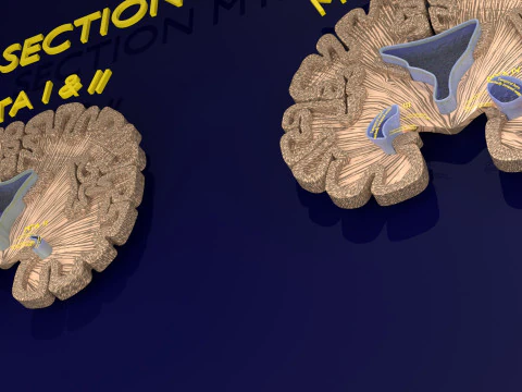 Hippocampus atrophy levels MTA 1-4 3D Model
