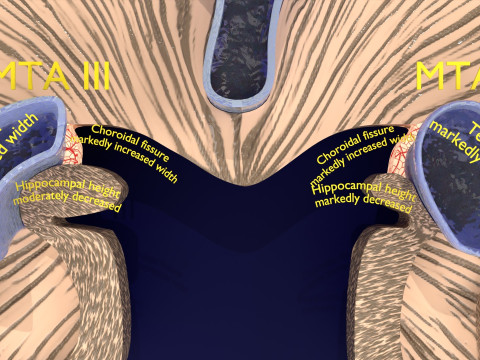 Hippocampus atrophy levels MTA 1-4 Model 3D