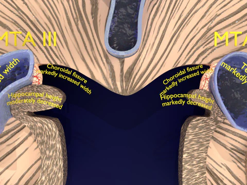 Hippocampus atrophy levels MTA 1-4 3D Model