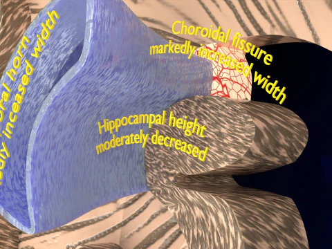 Hippocampus atrophy levels MTA 1-4 3D Model