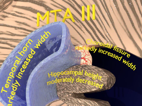 Hippocampus atrophy levels MTA 1-4 3D Model