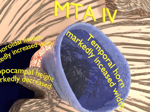 Hippocampus atrophy levels MTA 1-4 3D Model