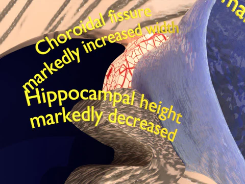 Hippocampus atrophy levels MTA 1-4 3D Model