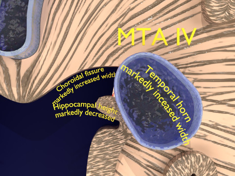 Hippocampus atrophy levels MTA 1-4 Model 3D