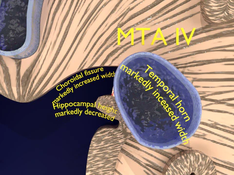 Hippocampus atrophy levels MTA 1-4 3D Model