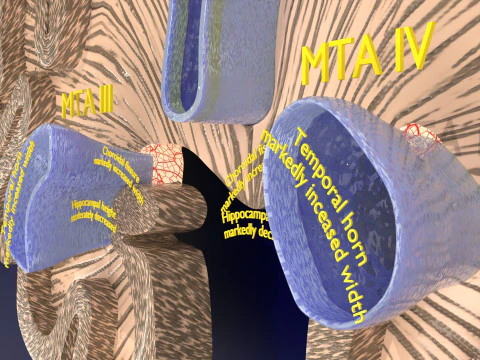 Hippocampus atrophy levels MTA 1-4 3D Model