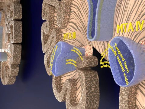 Hippocampus atrophy levels MTA 1-4 3D Model