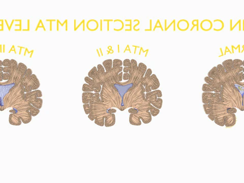 Hippocampus atrophy levels MTA 1-4 3D Model