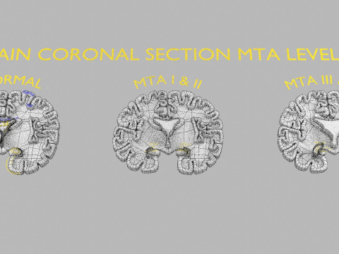 Hippocampus atrophy levels MTA 1-4 Model 3D