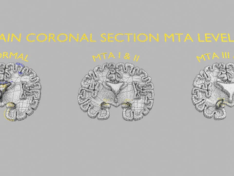 Hippocampus atrophy levels MTA 1-4 3D Model