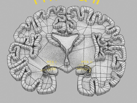 Hippocampus atrophy levels MTA 1-4 Model 3D