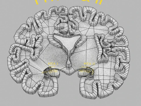 Hippocampus atrophy levels MTA 1-4 3D Model