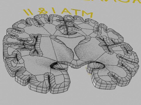 Hippocampus atrophy levels MTA 1-4 Model 3D