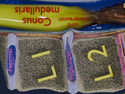 Intervertebral herniation slipped ruptured disc 3D Model