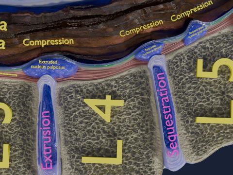 Intervertebral herniation slipped ruptured disc 3D Model