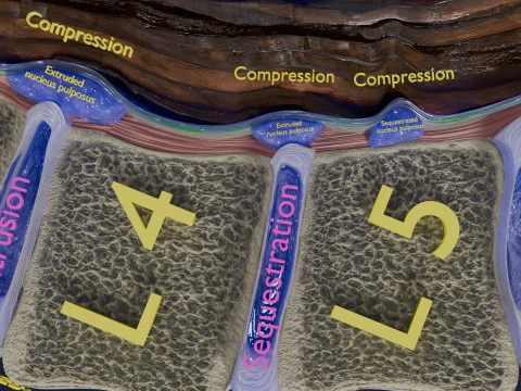 Intervertebral herniation slipped ruptured disc 3D Model