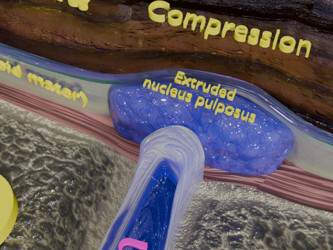Intervertebral herniation slipped ruptured disc 3D 모델