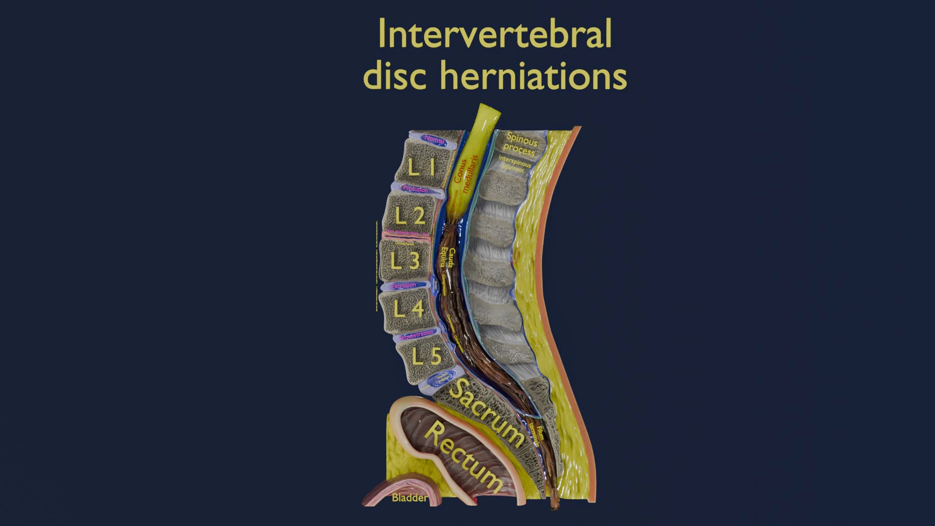 Intervertebral herniation slipped ruptured disc 3D Model .c4d .max .obj .3ds .fbx .stl .blend 