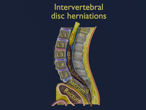 Intervertebral herniation slipped ruptured disc 3D Модель